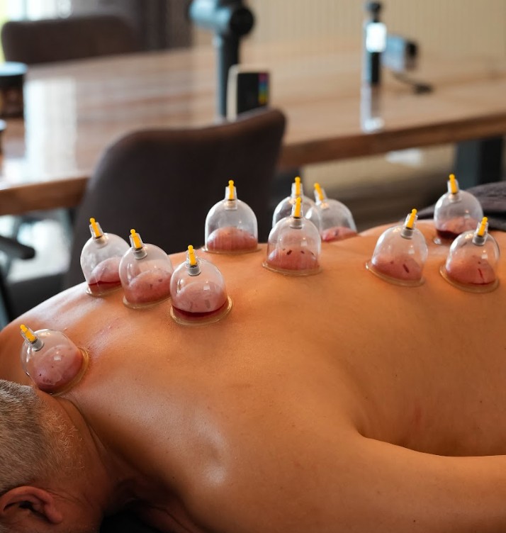 Hijama intégrale : ventouses sur tout le dos